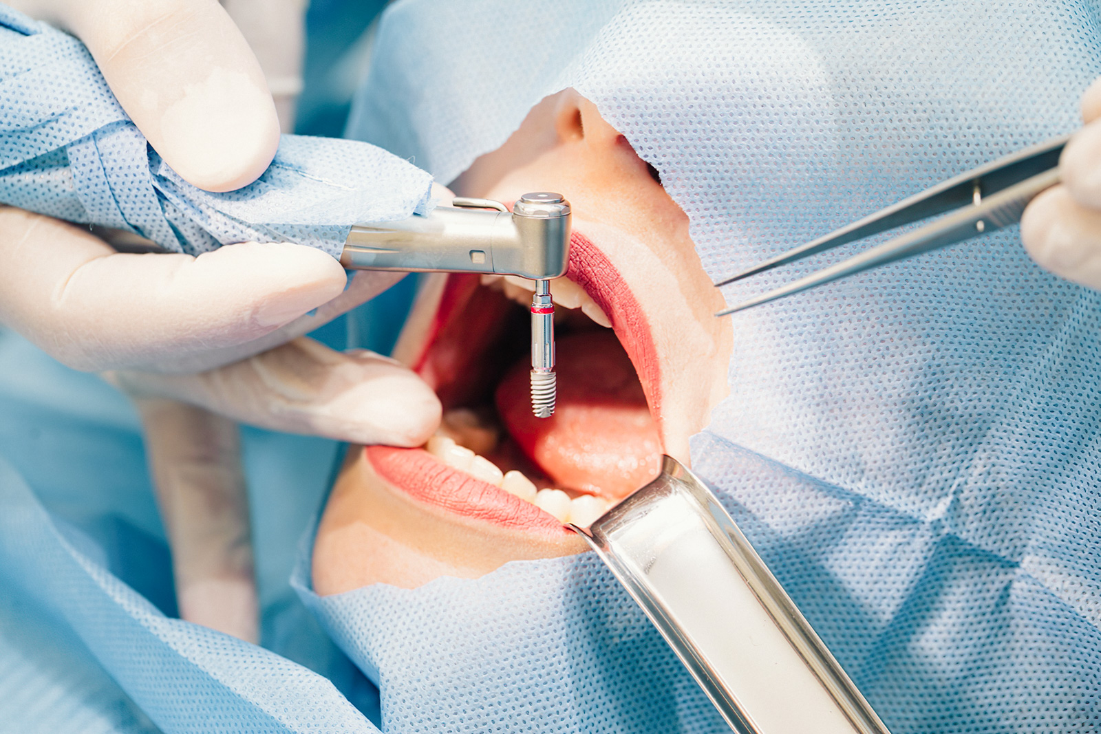 Implantodontia Jt Odontologia Integrada 8983